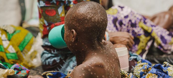 Uma criança sofrendo de mpox na unidade de isolamento do Hospital Kavumu, apoiado pela Unicef, na província de Kivu do Sul, República Democrática do Congo