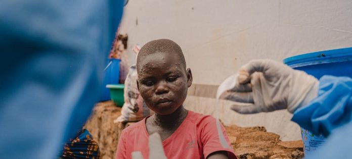 Um jovem paciente recebe tratamento na unidade de isolamento de mpox apoiada pelo Unicef no Hospital Kavumu, na província de Kivu do Sul, República Democrática do Congo.